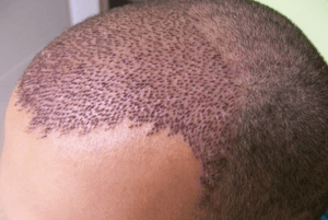 هزینه کاشت مو چقدر است؟