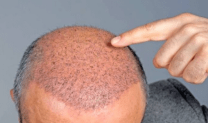     آیا نتیجه کاشت مو طبیعی دائمی است؟