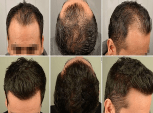عوارض کاشت مو چیست؟