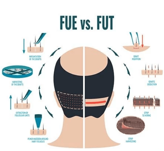 کاشت مو به روش fue vs fut