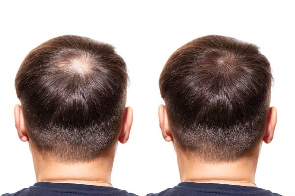 مقایسه روش های کاشت مو - کاشت مو به روش FUT