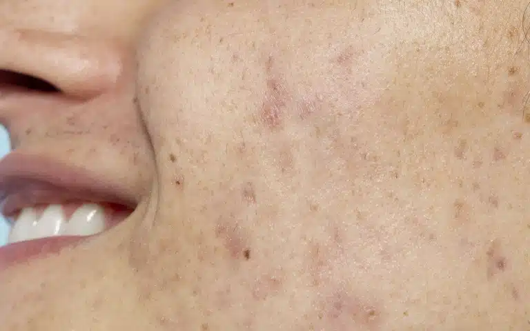 سابسیژن در پوست چرب به کاهش منافذ و بهبود اسکارهای آکنه‌ای می‌پردازد، در حالی که در پوست خشک برای درمان ترک‌ها و اسکارهای ناشی از خشکی مناسب است.